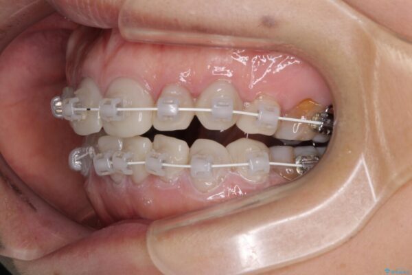 矯正の後戻りと変色歯を治したい　総合歯科診療 治療途中画像