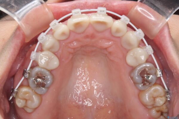 矯正の後戻りと変色歯を治したい　総合歯科診療 治療途中画像