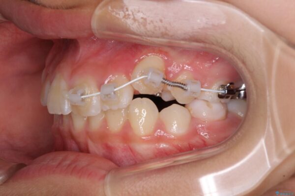 埋もれた犬歯を引っ張り出す　小学生のⅠ期治療 治療途中画像