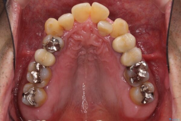 歯周病治療のための歯列矯正　総合歯科治療による全顎治療 治療前画像