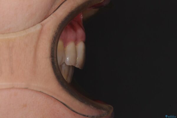 口元の閉じにくさを改善したい　ワイヤー装置での抜歯矯正 治療後画像
