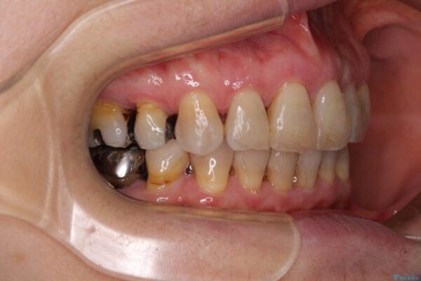 口元の閉じにくさを改善したい　ワイヤー装置での抜歯矯正 治療後画像