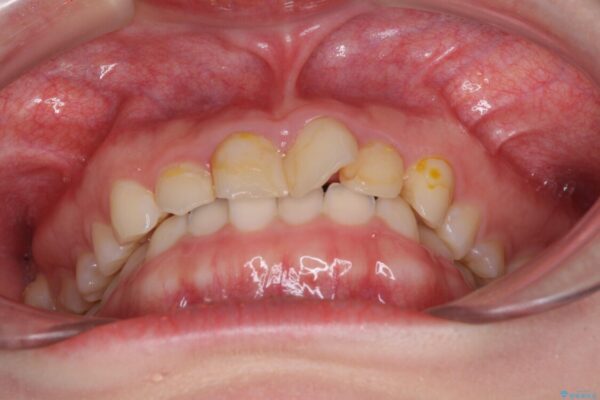 気になる前歯を美しく　マウスピース矯正とセラミッククラウン 治療前画像