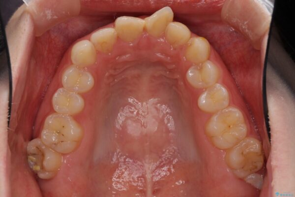 気になる前歯を美しく　マウスピース矯正とセラミッククラウン 治療前画像