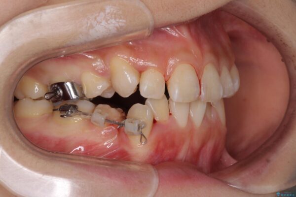 上下の八重歯を治したい　補助装置を用いたインビザライン矯正 治療途中画像