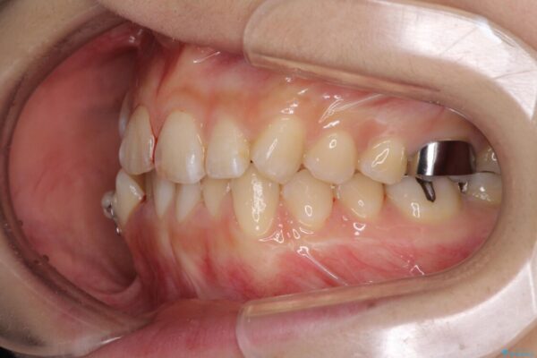上下の八重歯を治したい　補助装置を用いたインビザライン矯正 治療途中画像