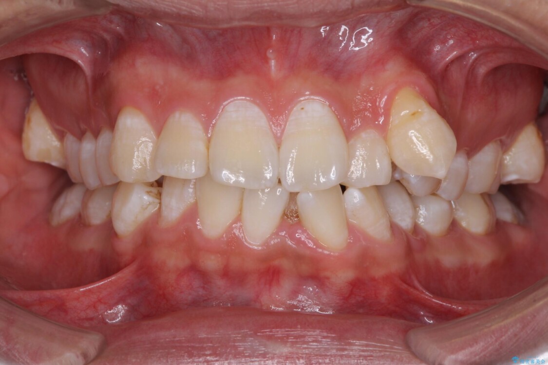 前歯の強いガタつきを解消　ワイヤー装置での抜歯矯正 治療前