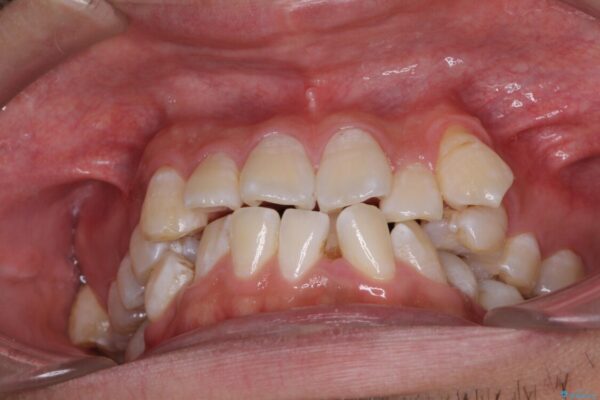前歯の強いガタつきを解消　ワイヤー装置での抜歯矯正 治療前画像