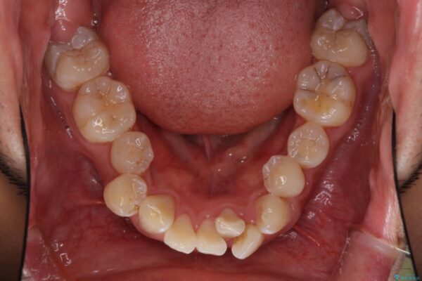 前歯の強いガタつきを解消　ワイヤー装置での抜歯矯正 治療前画像