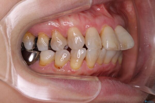口元の閉じにくさを改善したい　ワイヤー装置での抜歯矯正 治療前画像
