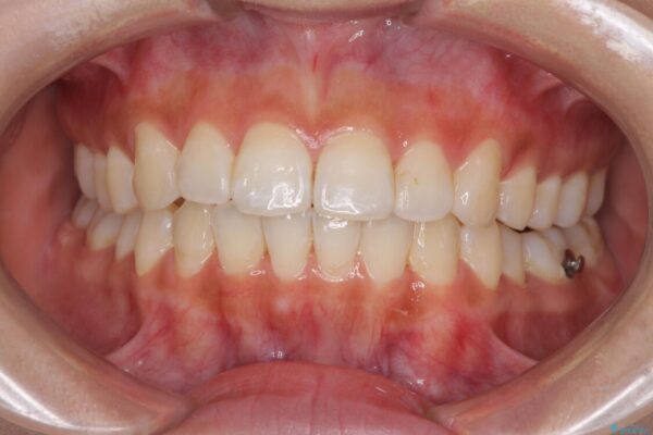 前歯のデコボコが気になる　インビザラインによる矯正治療 治療途中画像