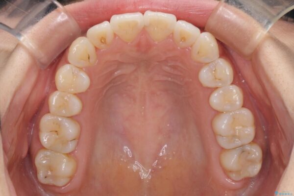 前歯のデコボコが気になる　インビザラインによる矯正治療 治療途中画像