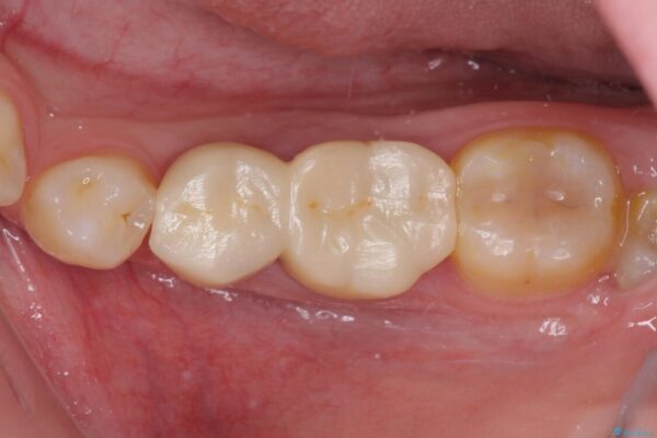奥深くまでの虫歯で歯茎が腫れる　部分矯正を用いた治療 治療前画像