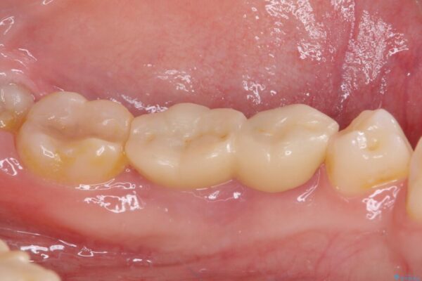 奥深くまでの虫歯で歯茎が腫れる　部分矯正を用いた治療 治療前画像