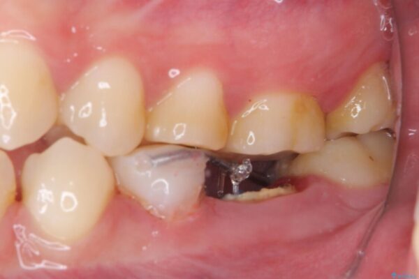 奥深くまでの虫歯で歯茎が腫れる　部分矯正を用いた治療 治療途中画像