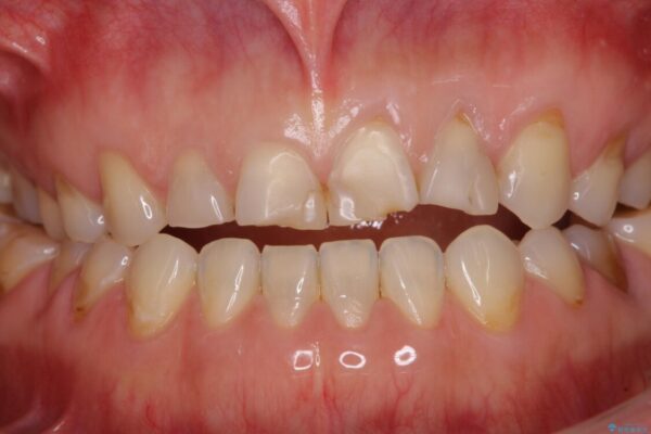 ガタガタの前歯をオールセラミッククラウンで自然な口元へ 治療前画像
