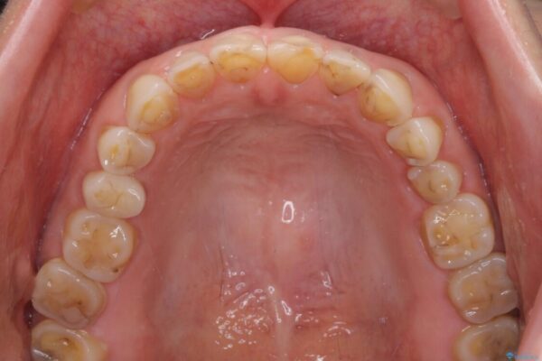 ガタガタの前歯をオールセラミッククラウンで自然な口元へ 治療前画像