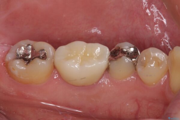 保険診療で装着した奥歯の白いクラウン　痛みが続くためセラミッククラウンへ 治療後画像