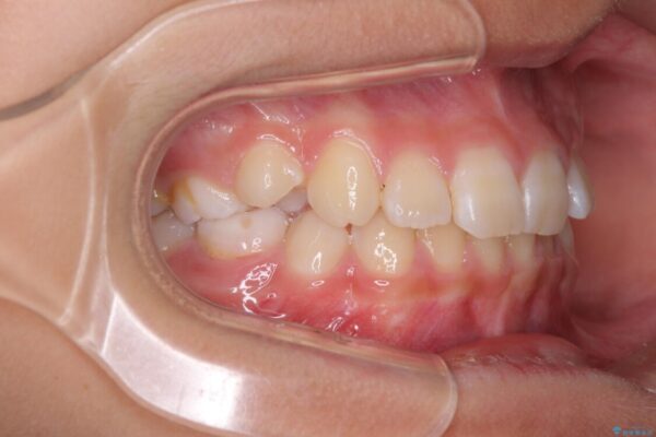 埋もれた犬歯を引っ張り出す　小学生のⅠ期治療 治療前画像