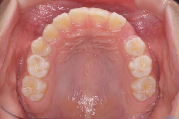 埋もれた犬歯を引っ張り出す　小学生のⅠ期治療 治療前画像