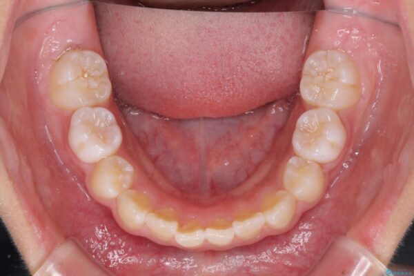 埋もれた犬歯を引っ張り出す　小学生のⅠ期治療 治療途中画像