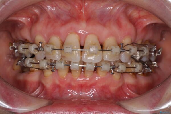 口元の閉じにくさを改善したい　ワイヤー装置での抜歯矯正 治療途中画像
