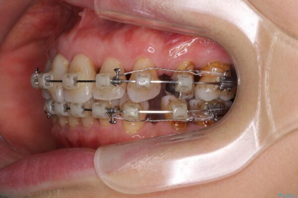 口元の閉じにくさを改善したい　ワイヤー装置での抜歯矯正 治療途中画像