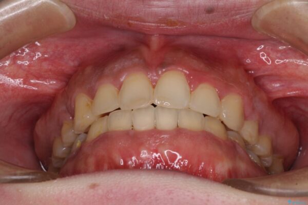 口元の突出感を改善　ワイヤー装置による抜歯矯正 治療後画像