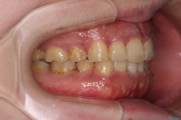 口元の突出感を改善　ワイヤー装置による抜歯矯正 治療後画像