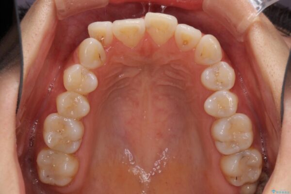 前歯のデコボコが気になる　インビザラインによる矯正治療 治療前画像