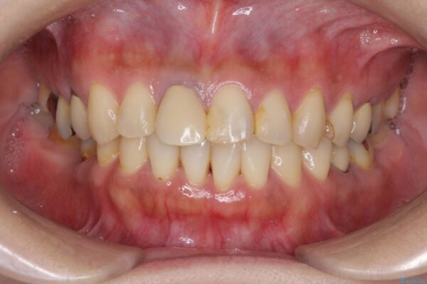 気になる部分を全て治療　総合歯科治療で口腔内環境改善 治療前画像