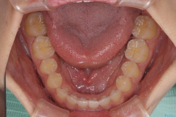 気になる隙間の再矯正　前歯をインビザライン・ライトで改善 治療後画像