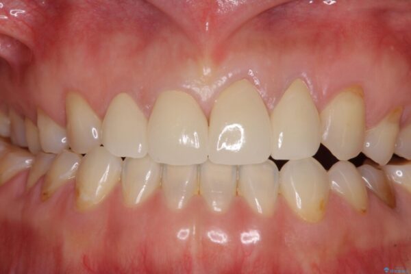 ガタガタの前歯をオールセラミッククラウンで自然な口元へ 治療後画像