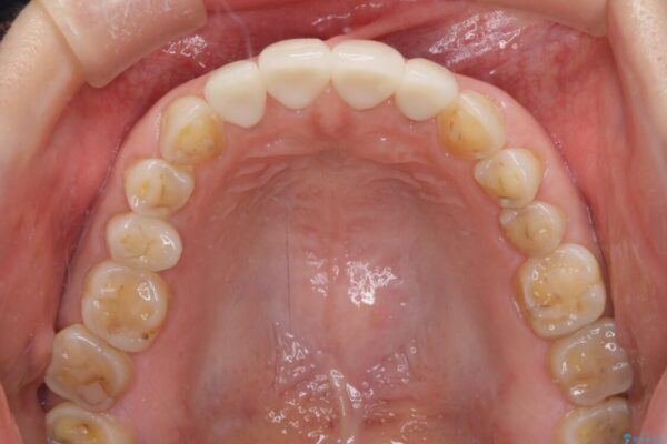 ガタガタの前歯をオールセラミッククラウンで自然な口元へ 治療後画像