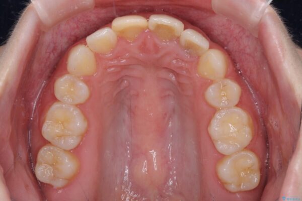 抜歯矯正の後戻り　インビザラインによるオープンバイトの再矯正 治療後画像
