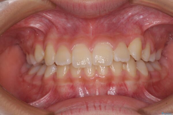 埋もれた犬歯を引っ張り出す　小学生のⅠ期治療 治療後画像