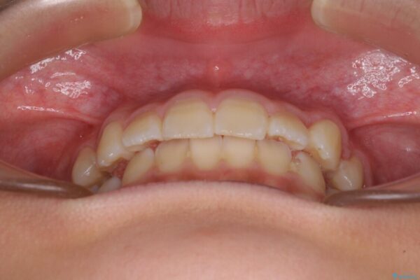 埋もれた犬歯を引っ張り出す　小学生のⅠ期治療 治療後画像
