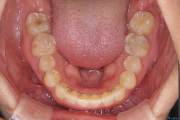 前歯の歯並びと小さい歯を改善　インビザラインとオールセラミッククラウン 治療途中画像