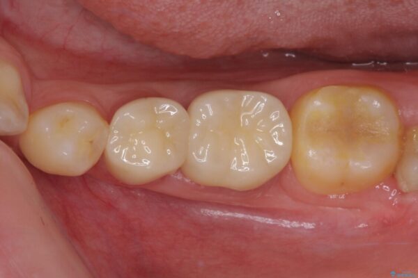 奥深くまでの虫歯で歯茎が腫れる　部分矯正を用いた治療 治療後画像