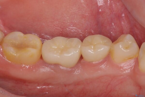 奥深くまでの虫歯で歯茎が腫れる　部分矯正を用いた治療 治療後画像