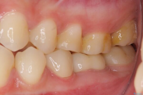 奥深くまでの虫歯で歯茎が腫れる　部分矯正を用いた治療 アフター