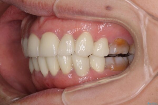 矯正の後戻りと変色歯を治したい　総合歯科診療 治療後画像