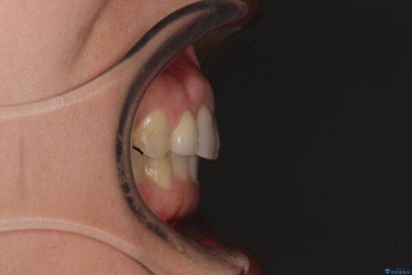 前歯の歯並びと小さい歯を改善　インビザラインとオールセラミッククラウン 治療後画像