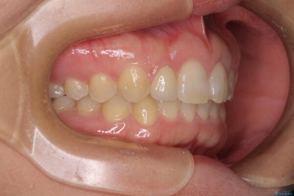 前歯の歯並びと小さい歯を改善　インビザラインとオールセラミッククラウン 治療後画像