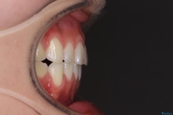 上下の八重歯を治したい　補助装置を用いたインビザライン矯正 治療後画像