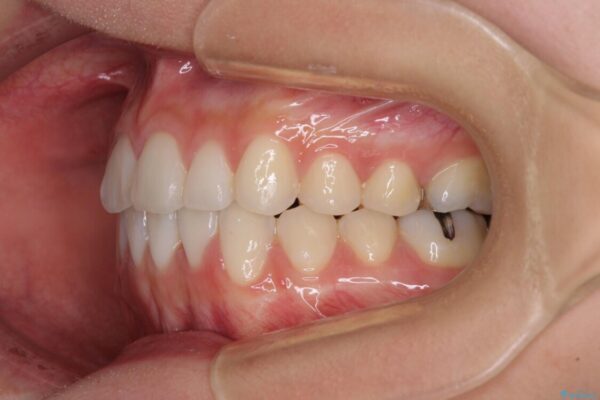 上下の八重歯を治したい　補助装置を用いたインビザライン矯正 治療後画像