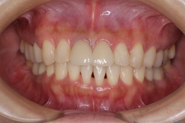 気になる部分を全て治療　総合歯科治療で口腔内環境改善 治療後画像