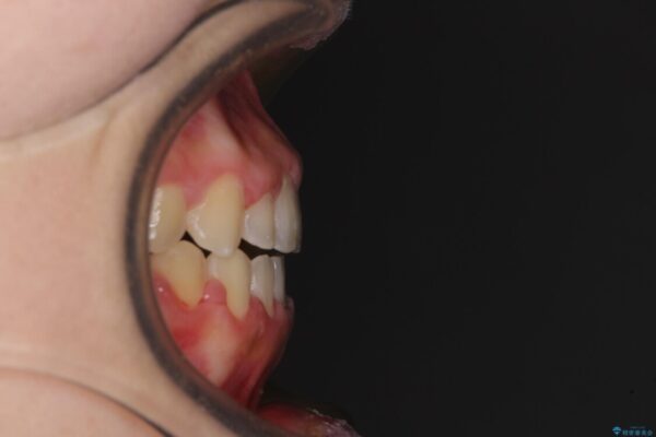 外科矯正は受けたくない　上顎骨拡大による妥協的な受け口治療 治療後画像