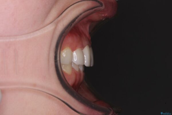 気になる前歯を美しく　マウスピース矯正とセラミッククラウン 治療後画像