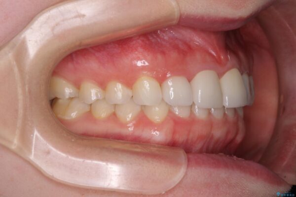 気になる前歯を美しく　マウスピース矯正とセラミッククラウン 治療後画像